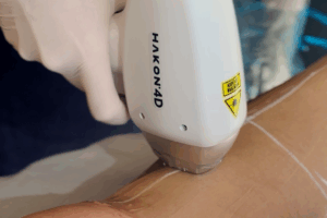 Depilacao-a-Laser-em-4D-com-Hakon-Tecnologia-Conforto-e-Resultados